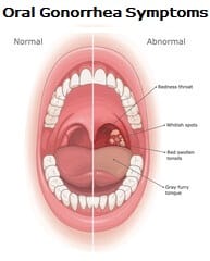 GC STD oral gonorrhea symptoms