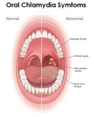 symptoms of oral chlamydia